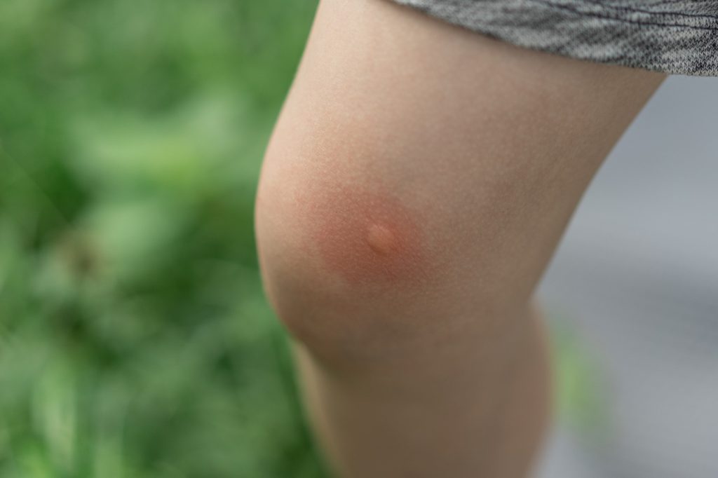  Infected Insect Bite in Farnham Common