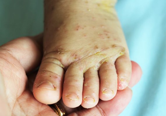 Impetigo treatment in Gerrards Cross