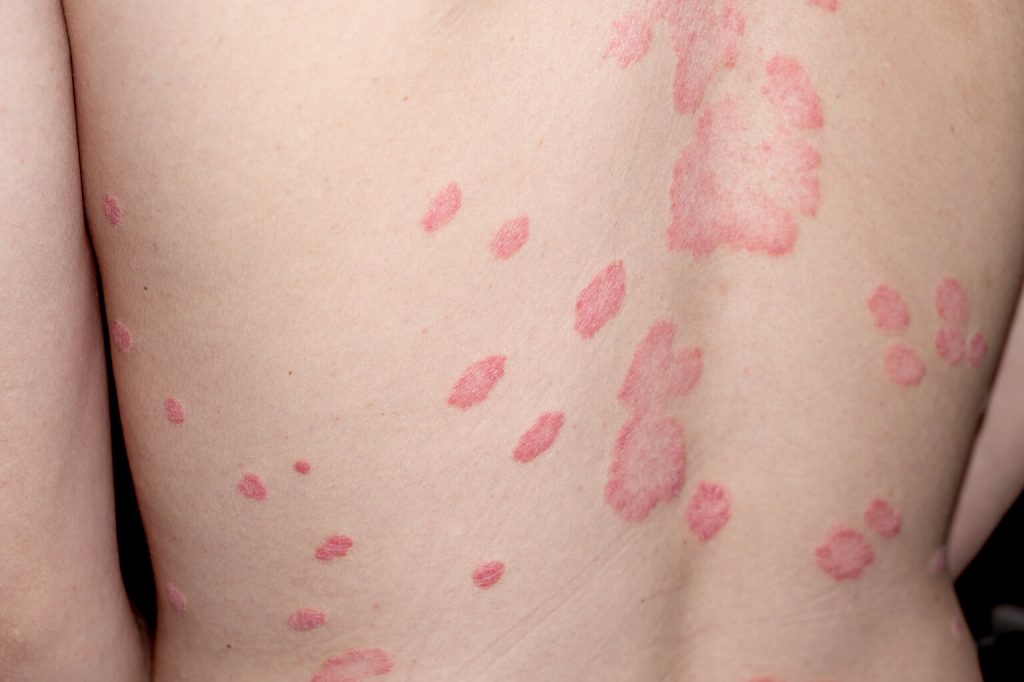 Best Treatment for Shingles