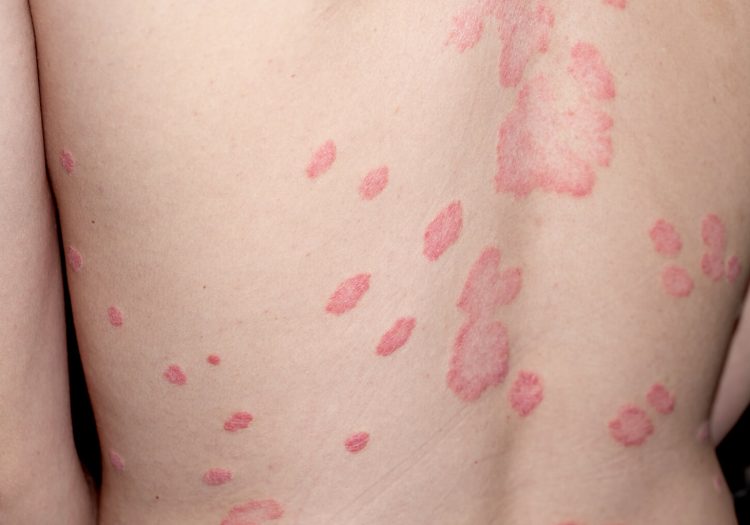 Best Treatment for Shingles