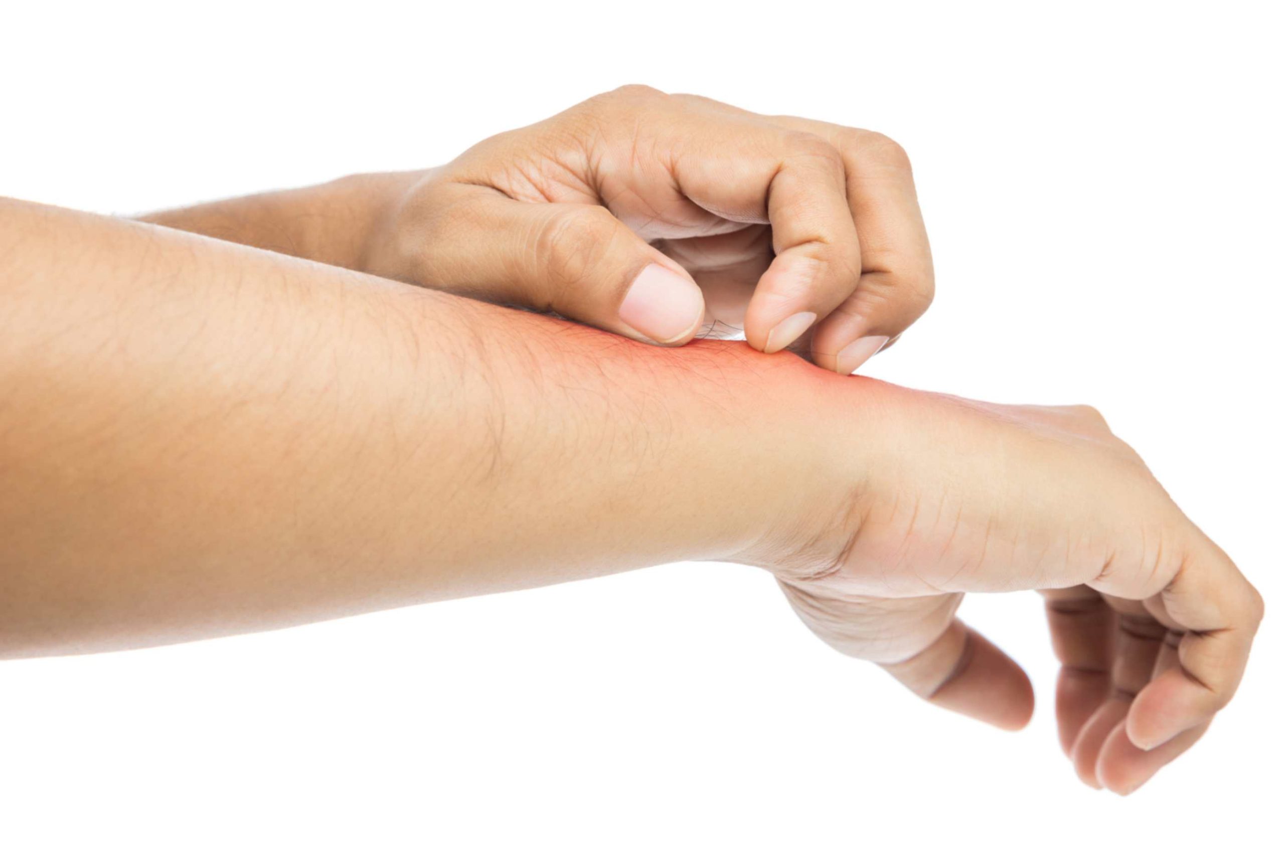 Guide to Insect Bites: Types, Symptoms and Treatments - Aroga Pharmacy