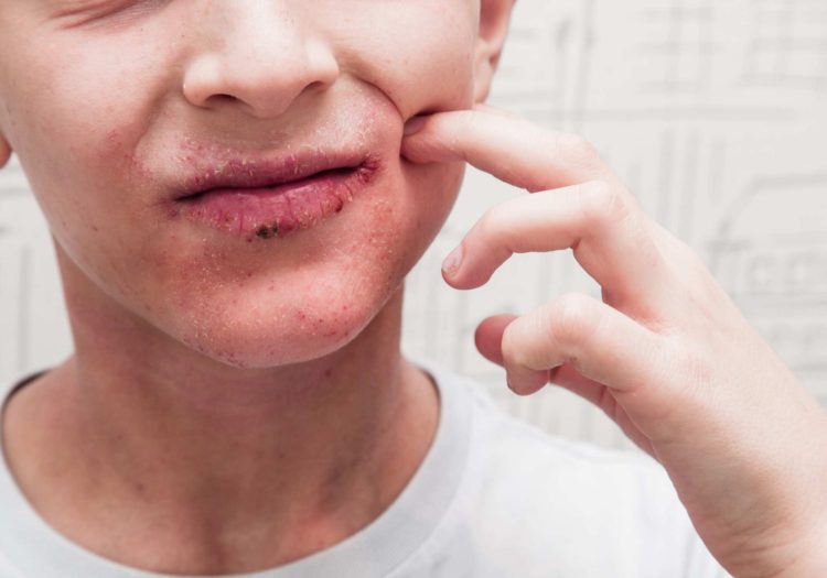 Impetigo treatment over the counter