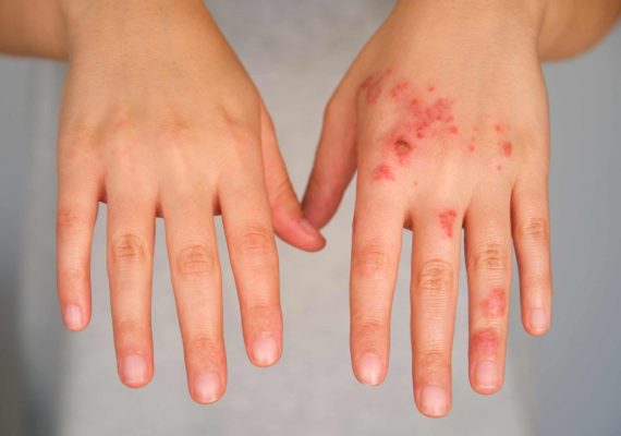 Impetigo symptoms