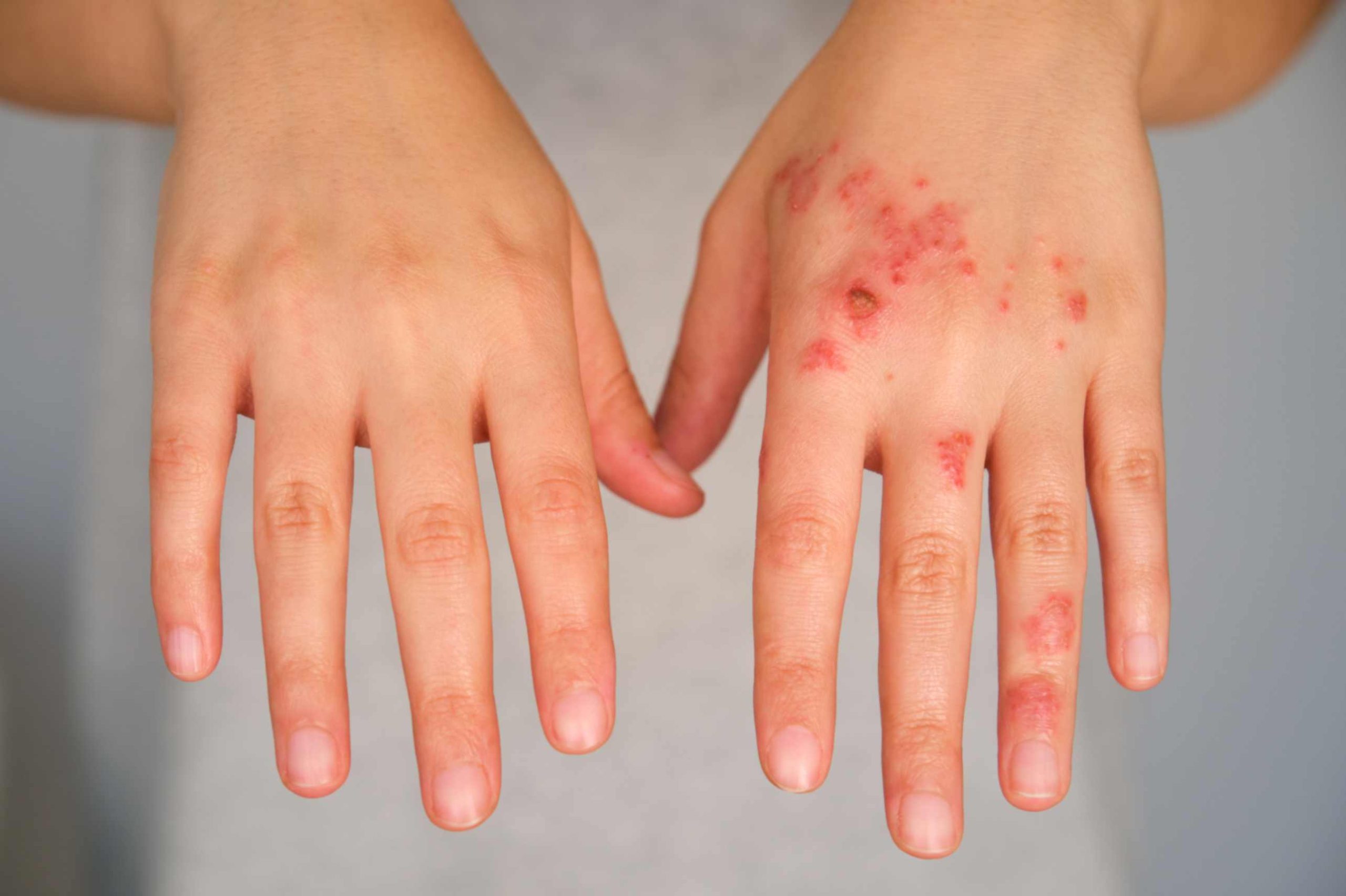 How to Identify the Early Symptoms of Impetigo - Aroga Pharmacy